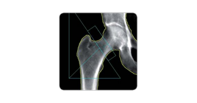 Read more about the article A importância da desintometria óssea para auxiliar no diagnóstico da osteoporose